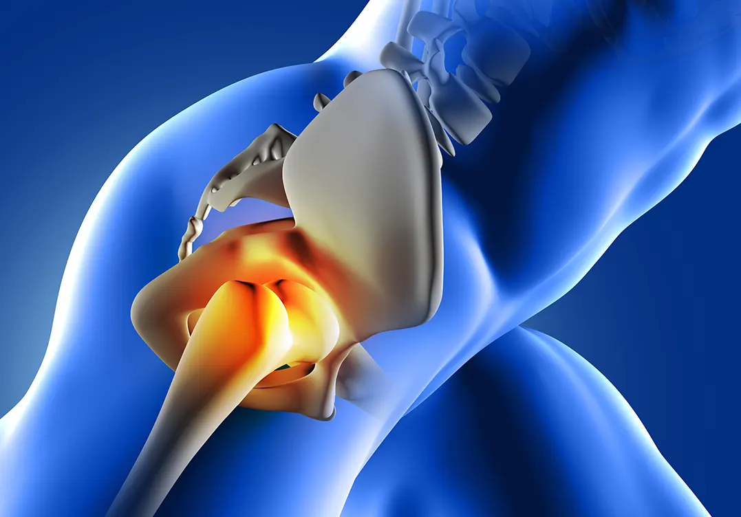Labrum Tear