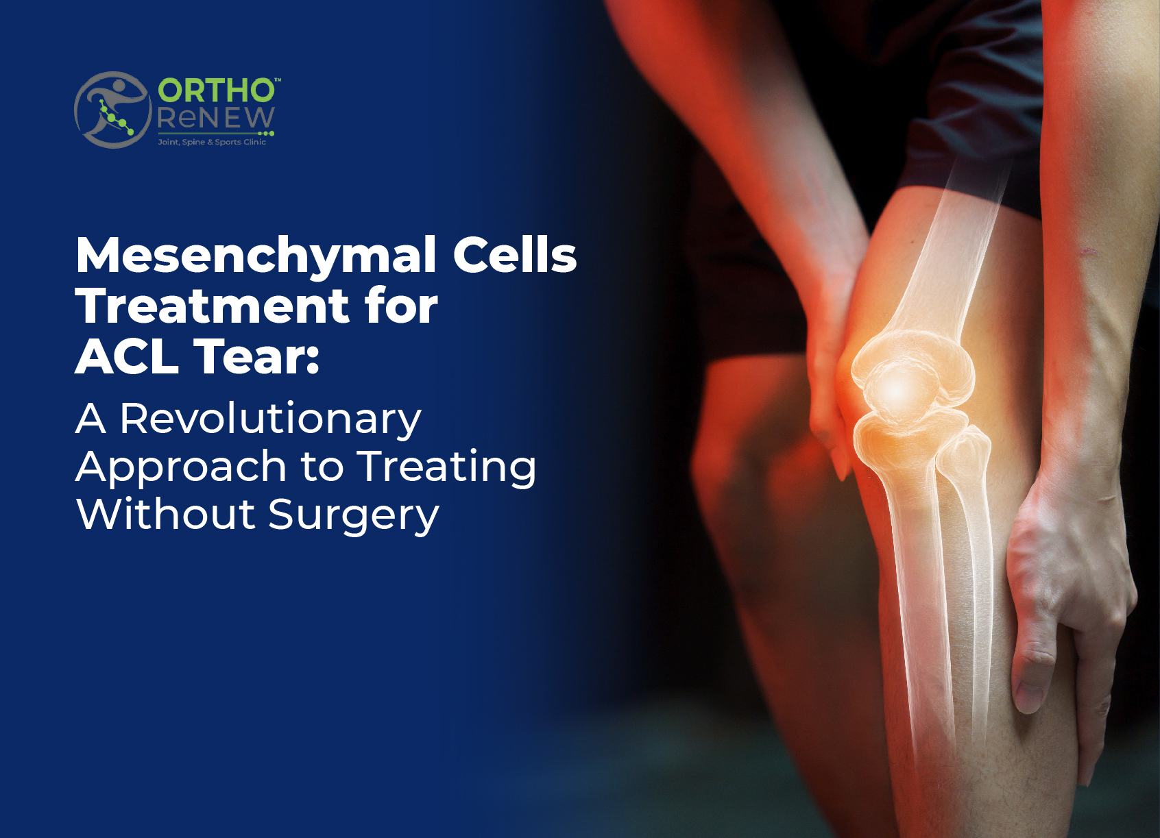 Mesenchymal cells Treatment for ACL Tear: A Revolutionary Approach to Treating Without Surgery