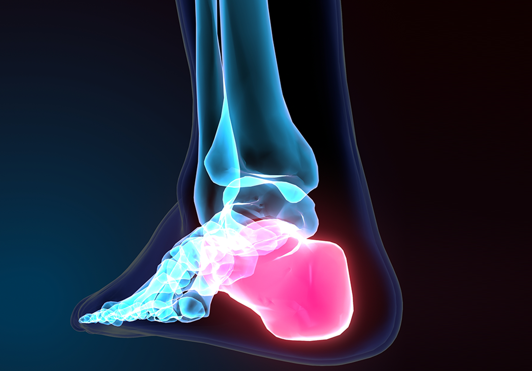 Ankle Osteoarthritis