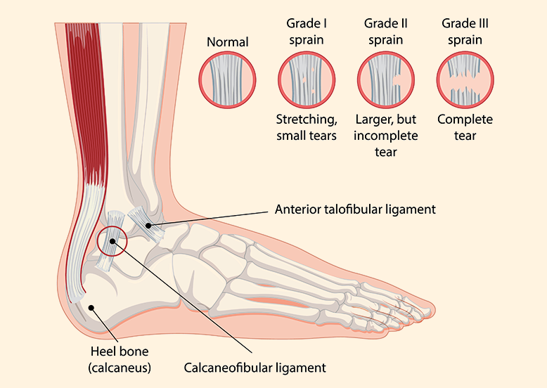 Ankle Tendon Tears Chart
