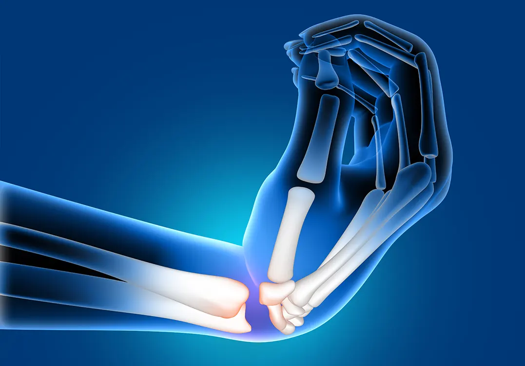 Sciatica