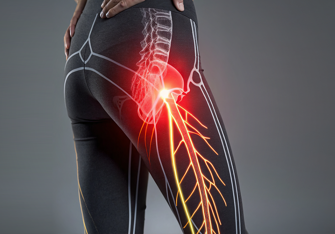 Sciatica