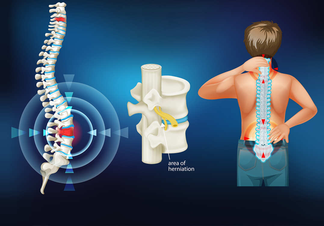 Herniated Discs